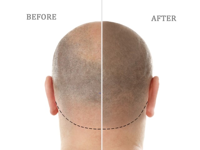 scalp micro pigmentation